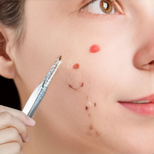 Roestvrijstalen Acne Verwijderingspincet